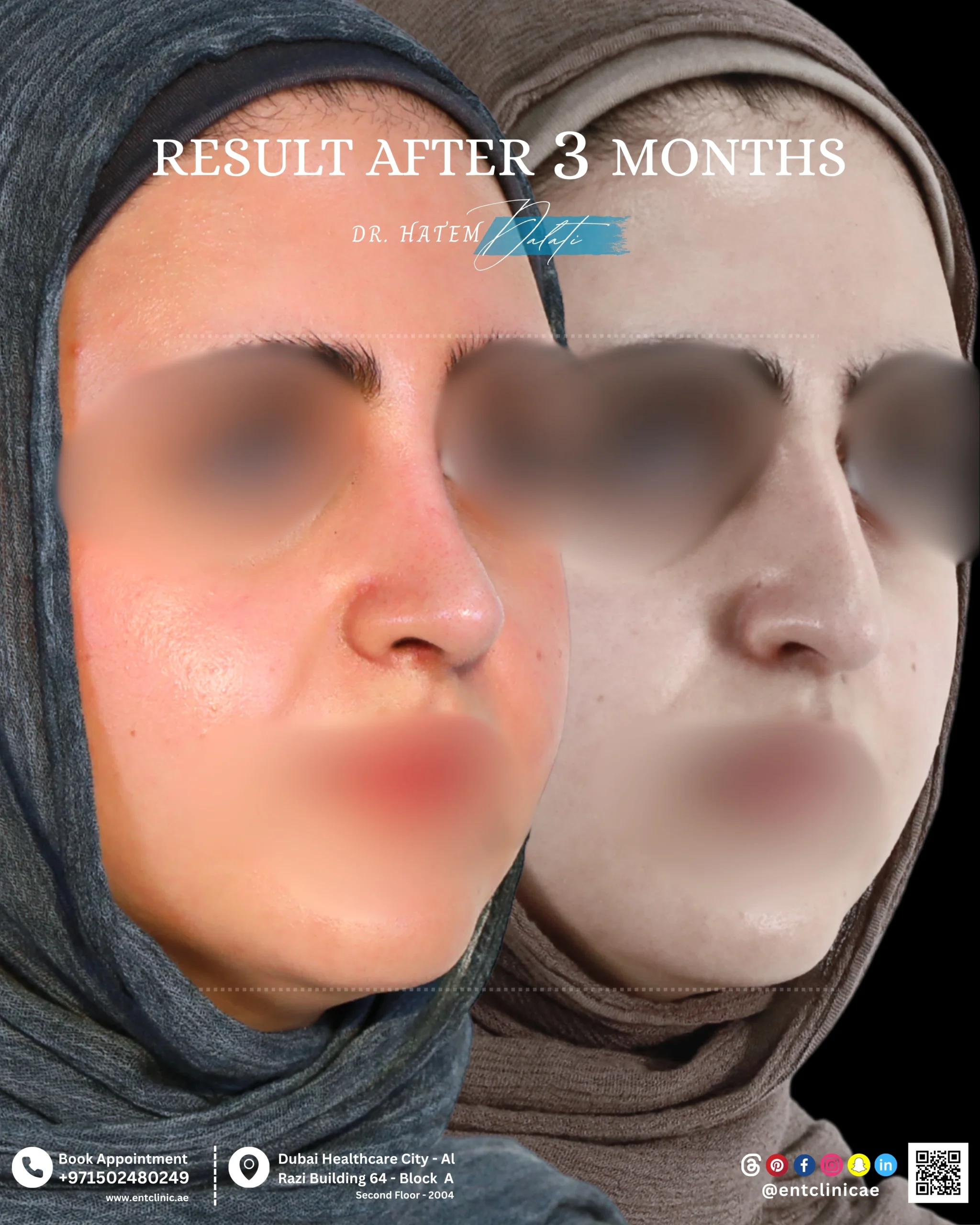 Patient before and 3 months after rhinoplasty showing a refined and balanced nasal profile in three quarter view