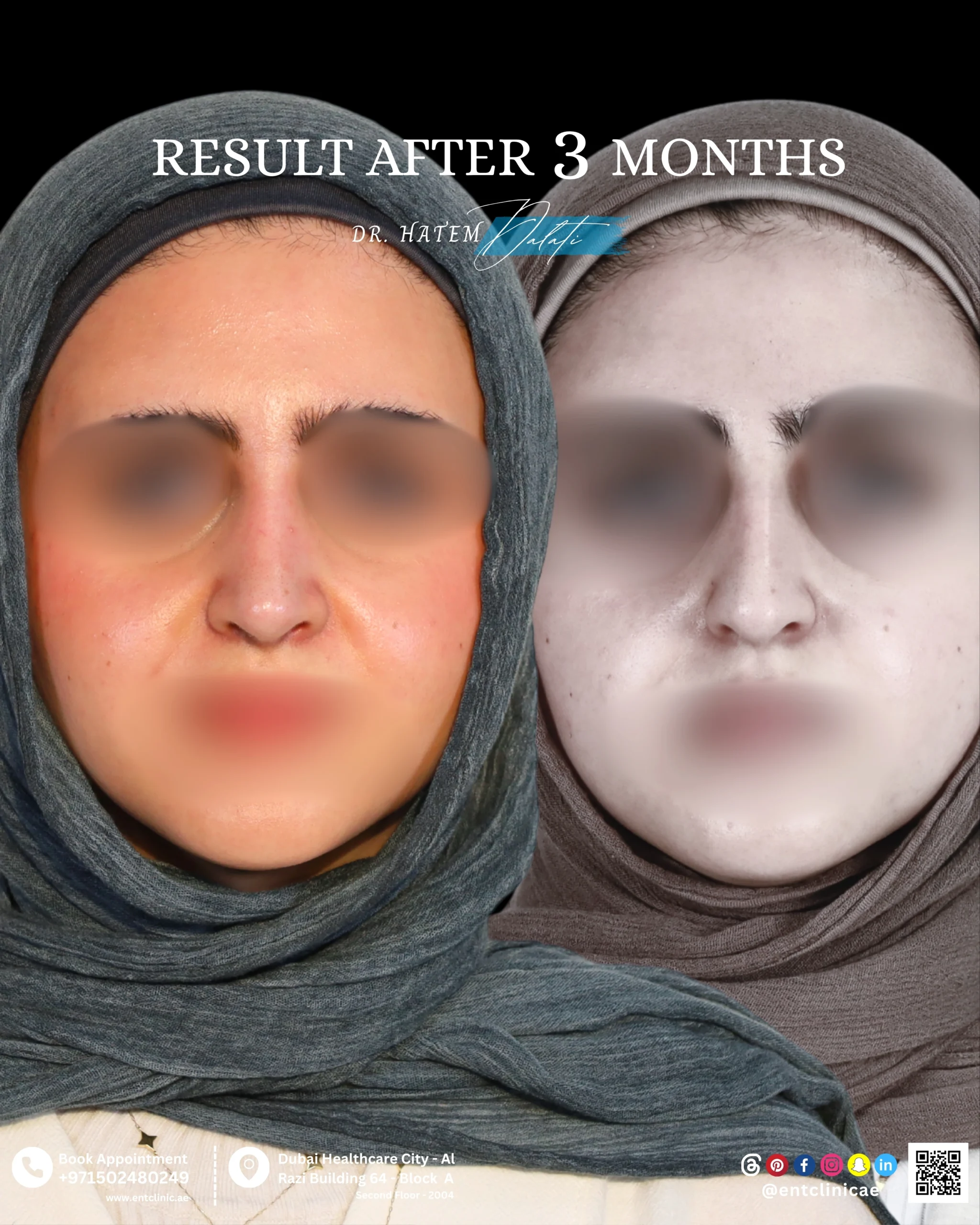 Patient front profile before and 3 months after rhinoplasty showing a refined and balanced nasal profile