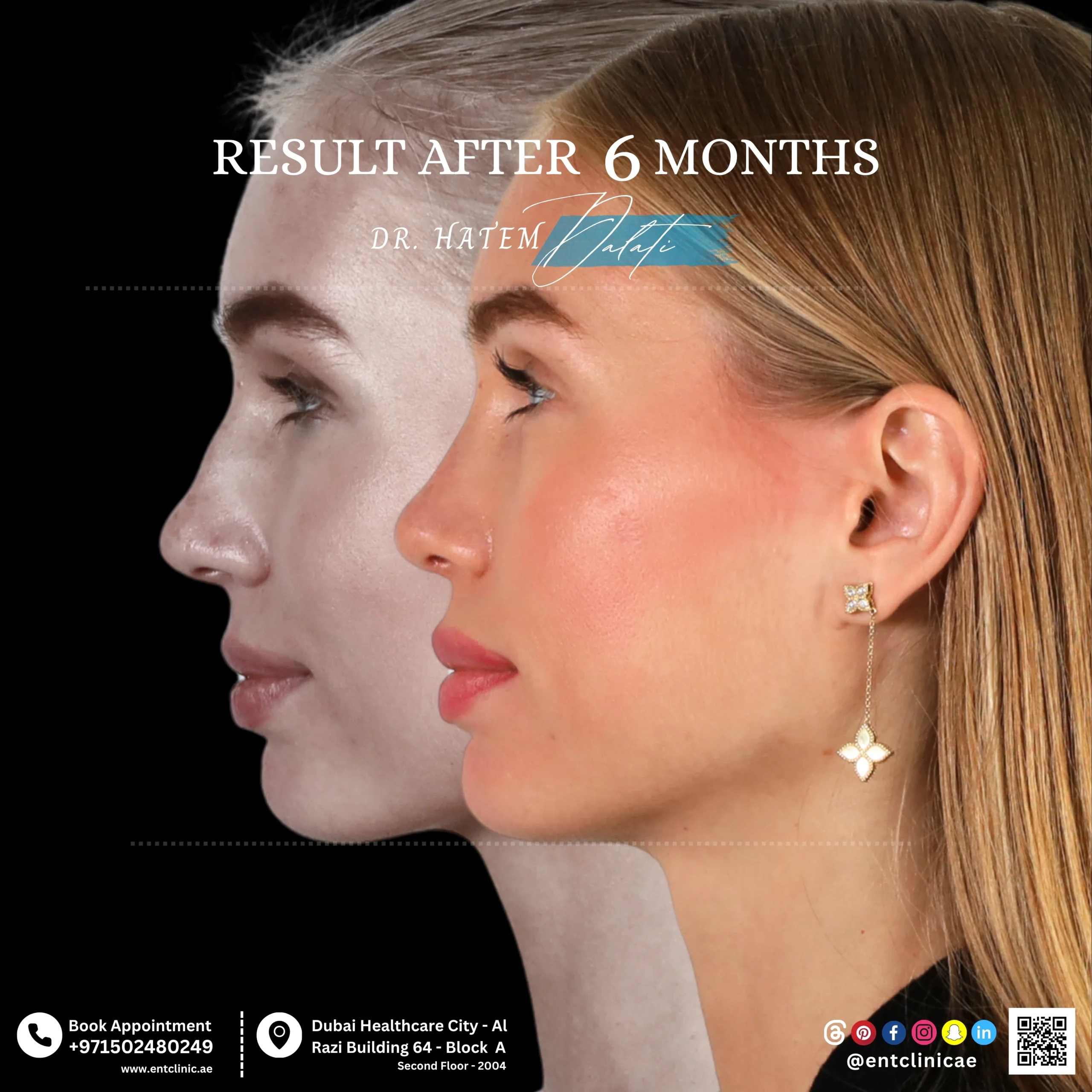 Rhinoplasty patient profile view before and after 6 months after surgery showing a natural and balanced