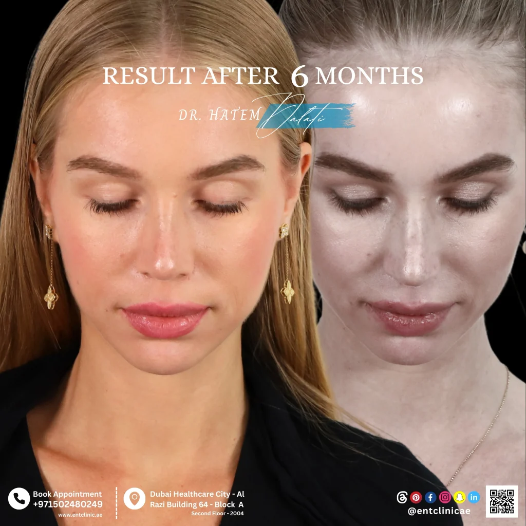 Rhinoplasty Patient front view before and after 6 months after surgery showing a natural and balanced