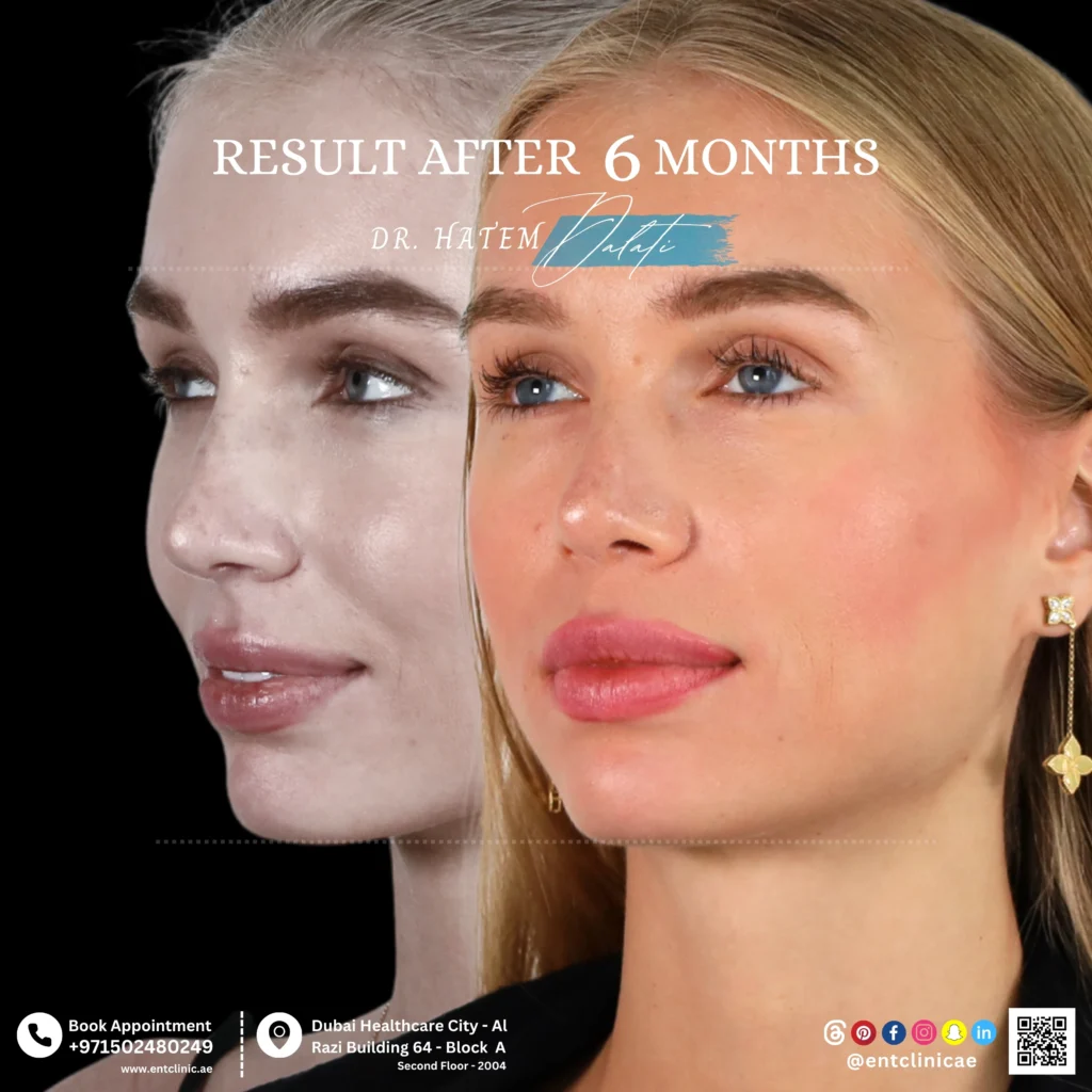 Rhinoplasty Patient before and after 6 months after surgery showing a natural and balanced in three quarter view
