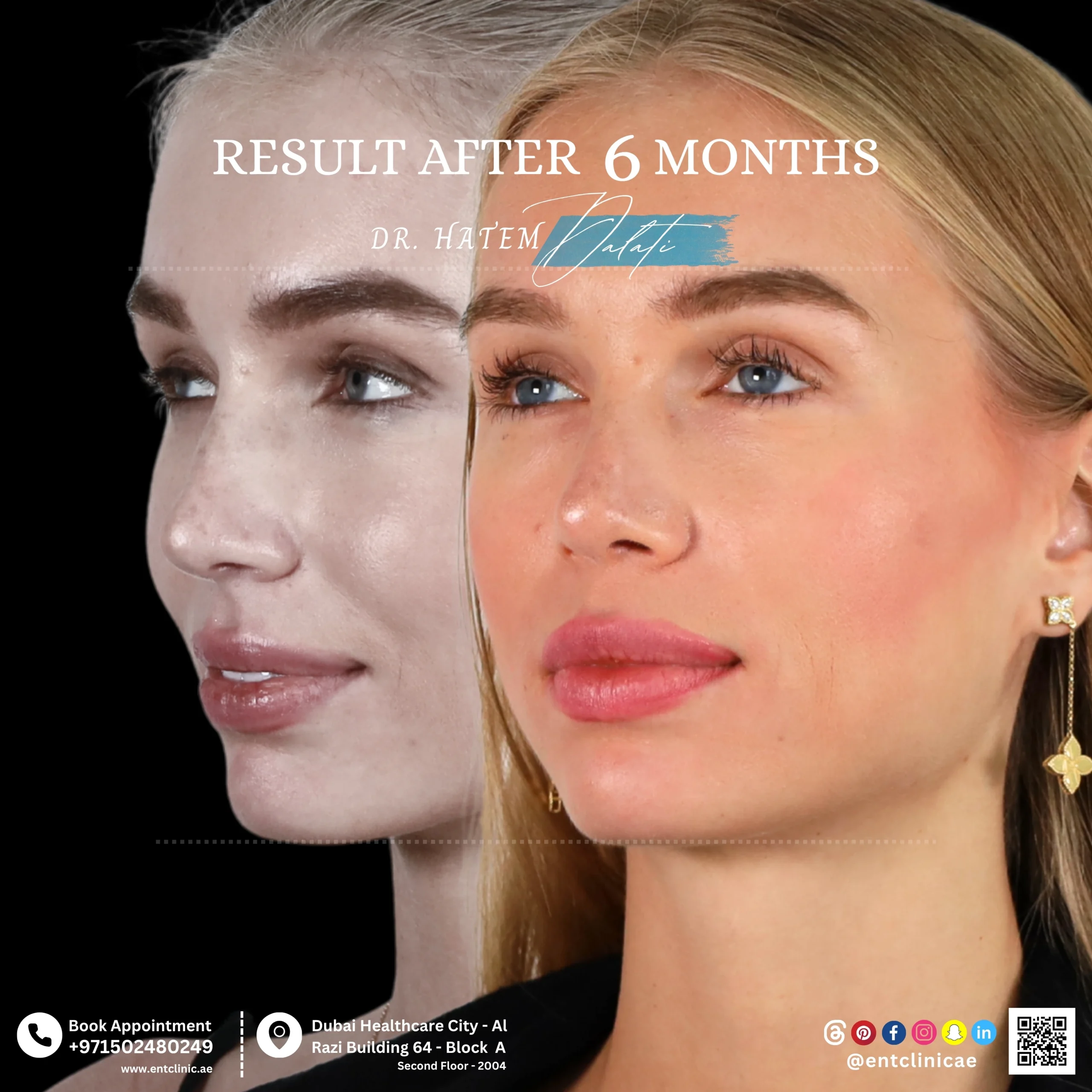 Rhinoplasty patient before and after 6 months after surgery showing a natural and balanced in three quarter view