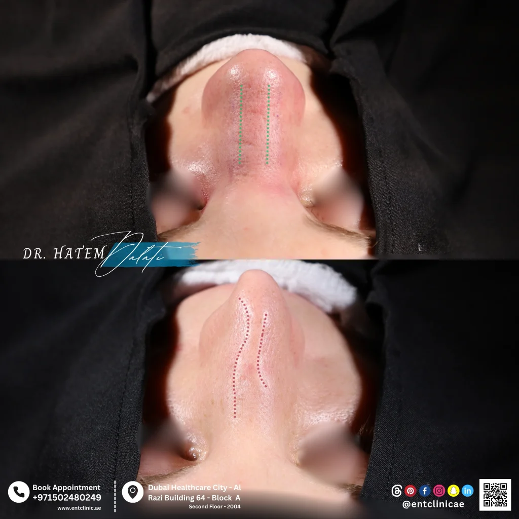 قبل وبعد عملية تجميل الأنف الترميمية
