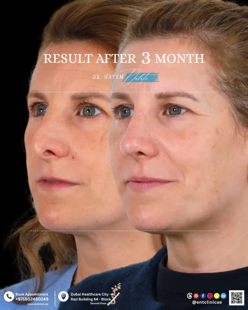 Patient before and 3 months after functional and cosmetic rhinoplasty showing a natural and balanced nasal result in three quarter view