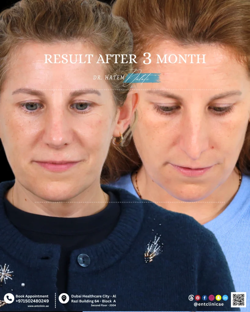 Patient front profile before and 3 months after functional and cosmetic rhinoplasty showing a natural and balanced nasal result