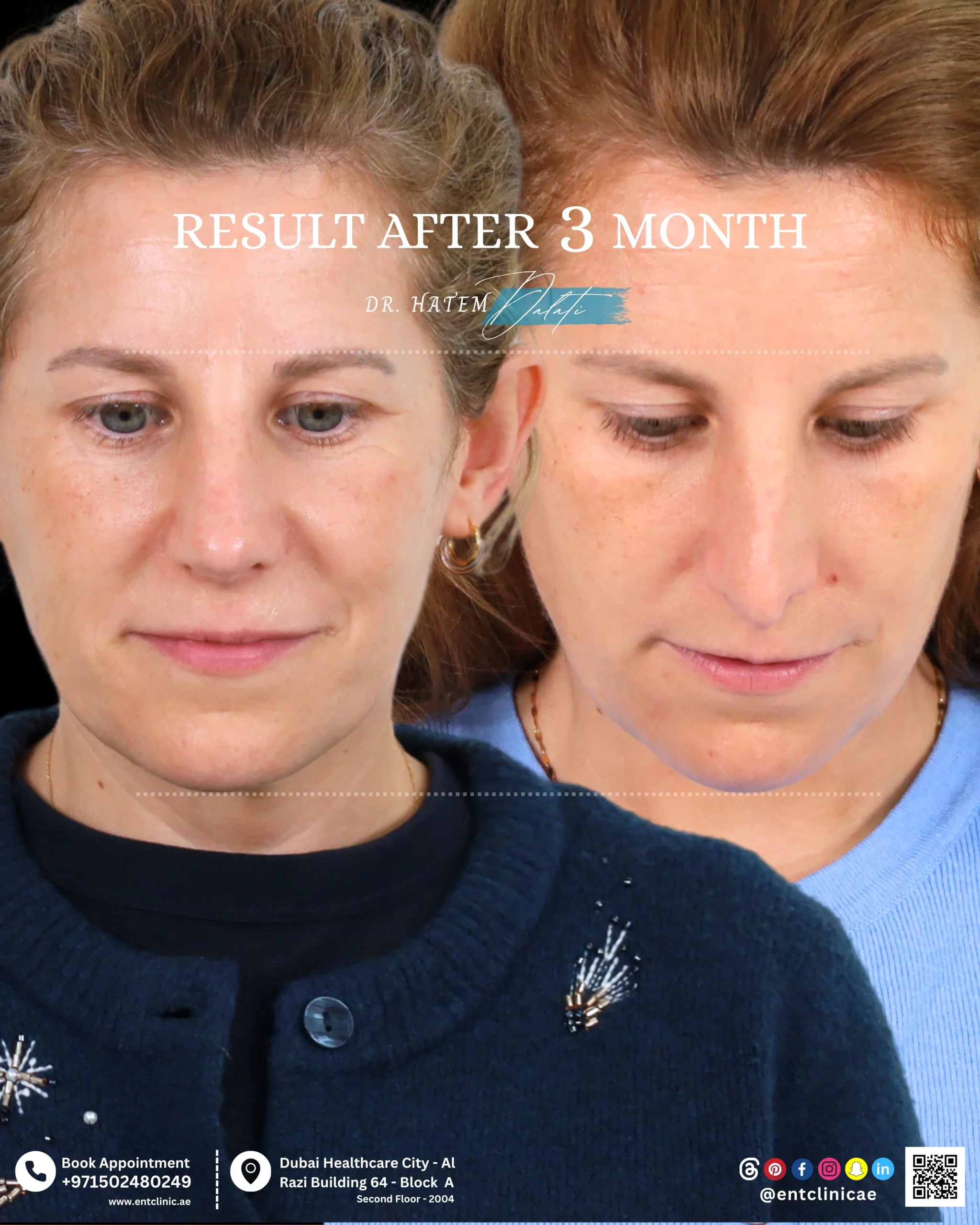 Patient front profile before and 3 months after functional and cosmetic rhinoplasty showing a natural and balanced nasal result