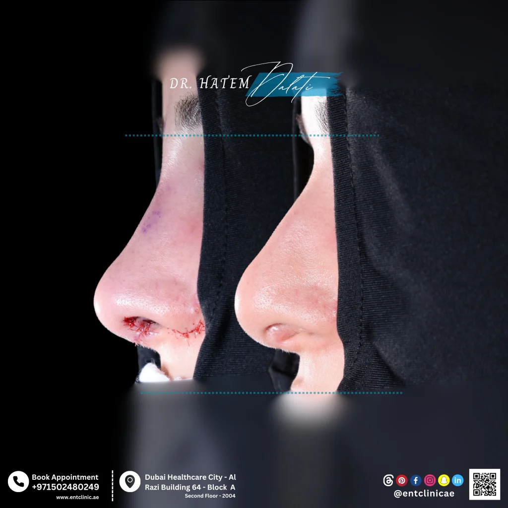 Side profile before and after revision septorhinoplasty showing improved nasal contour, tip position, and nasal symmetry