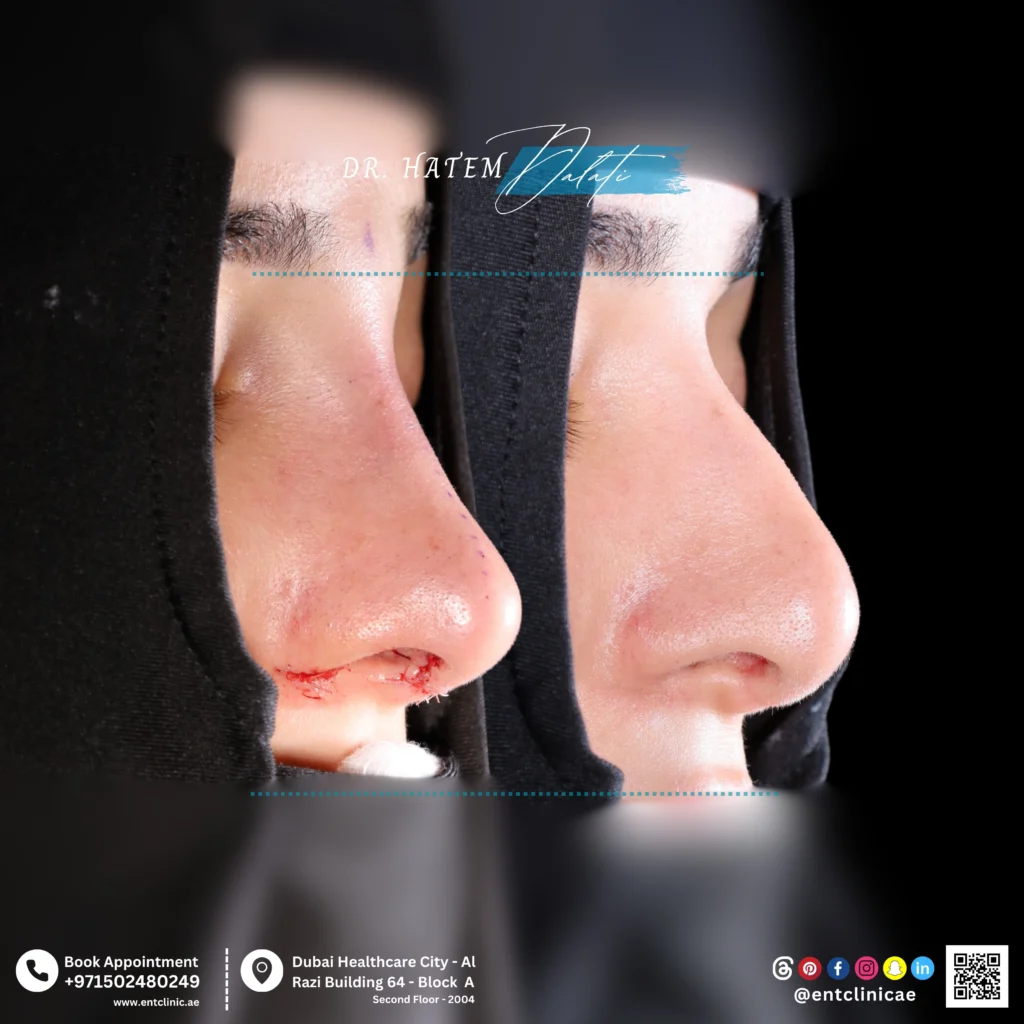 عملية تجميل الأنف والحاجز الأنفي التصحيحية، مع تصغير القرينات الأنفية على الجانبين واستخدام طعوم غضروفية