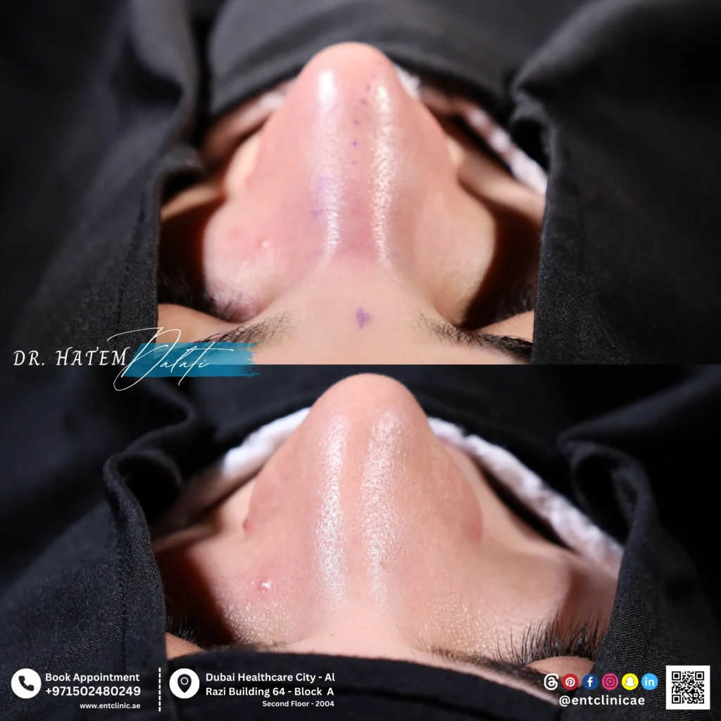 Before and after revision septorhinoplasty showing structural nasal refinement in septal view