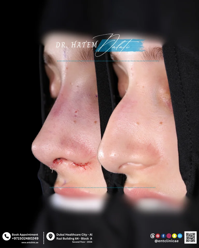نتائج قبل وبعد عملية رأب الحاجز الأنفي وتجميل الأنف الأولية، توضح التغييرات المصممة وفقًا لحالة المريض في بنية الأنف ومظهره العام.