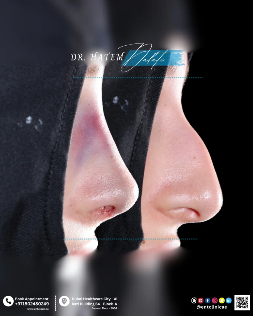 Before and after primary septorhinoplasty showing nasal structural changes in profile view