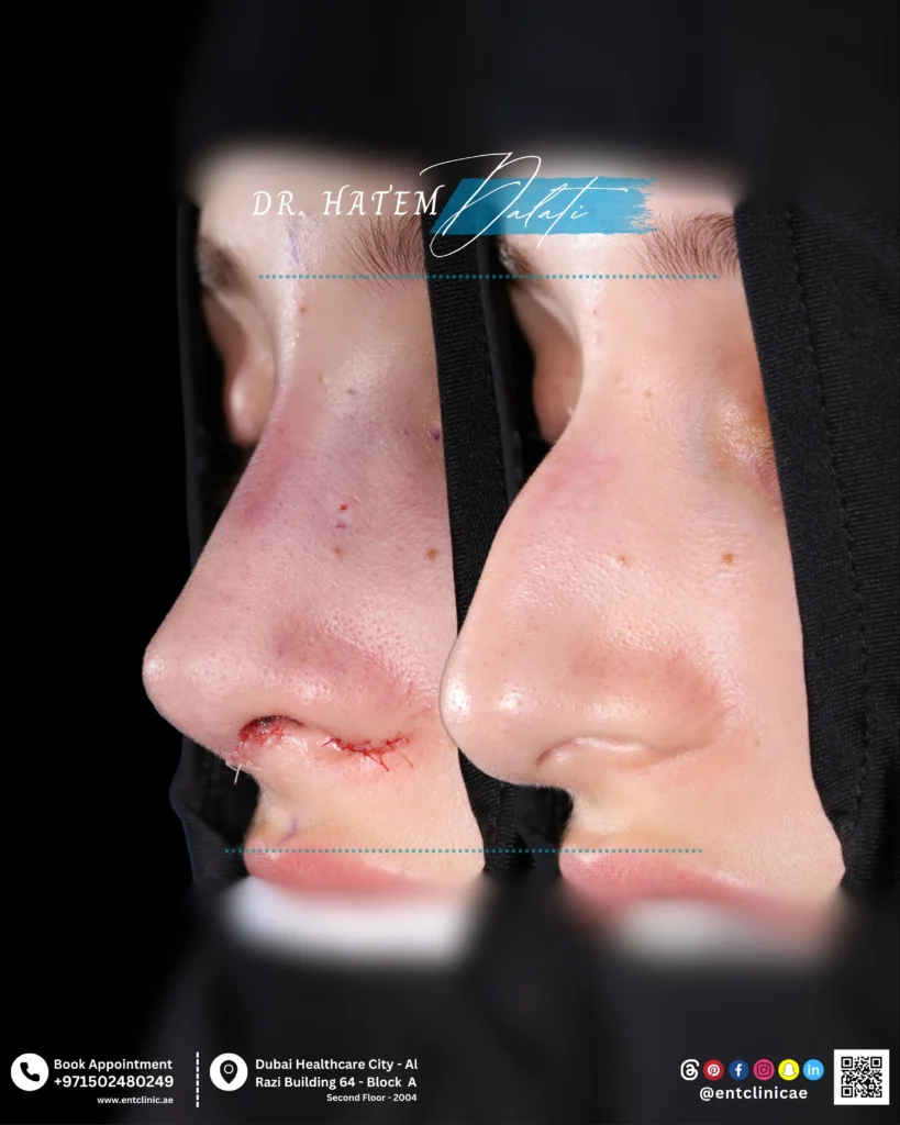 Before and after primary septorhinoplasty showing nasal structural changes in three quarter view