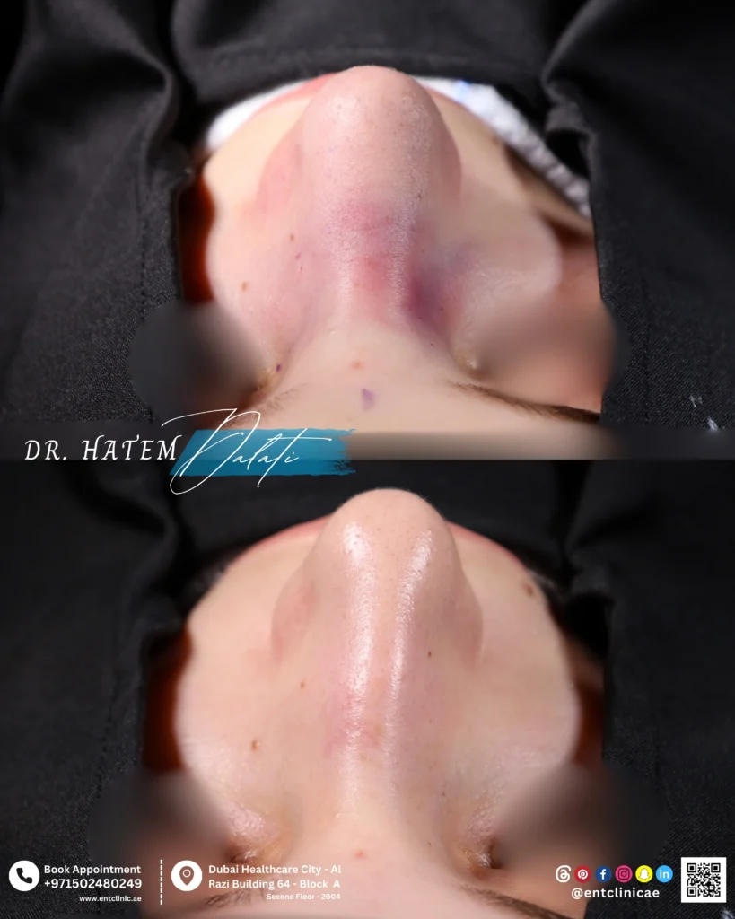 Before and after primary septorhinoplasty showing nasal structural changes in septal view