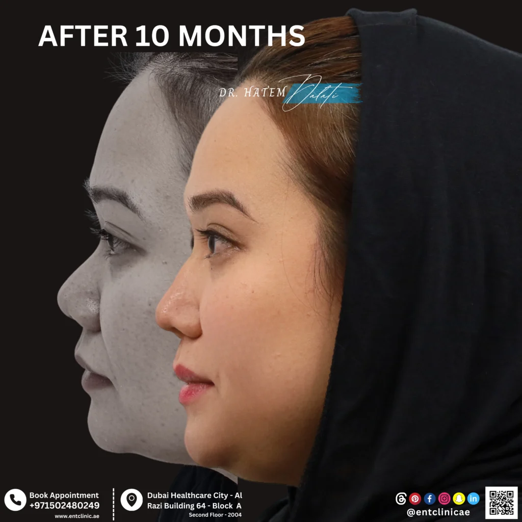 Patient side profile before and 10 months after ethnic rhinoplasty showing natural nasal refinement while maintaining facial identity