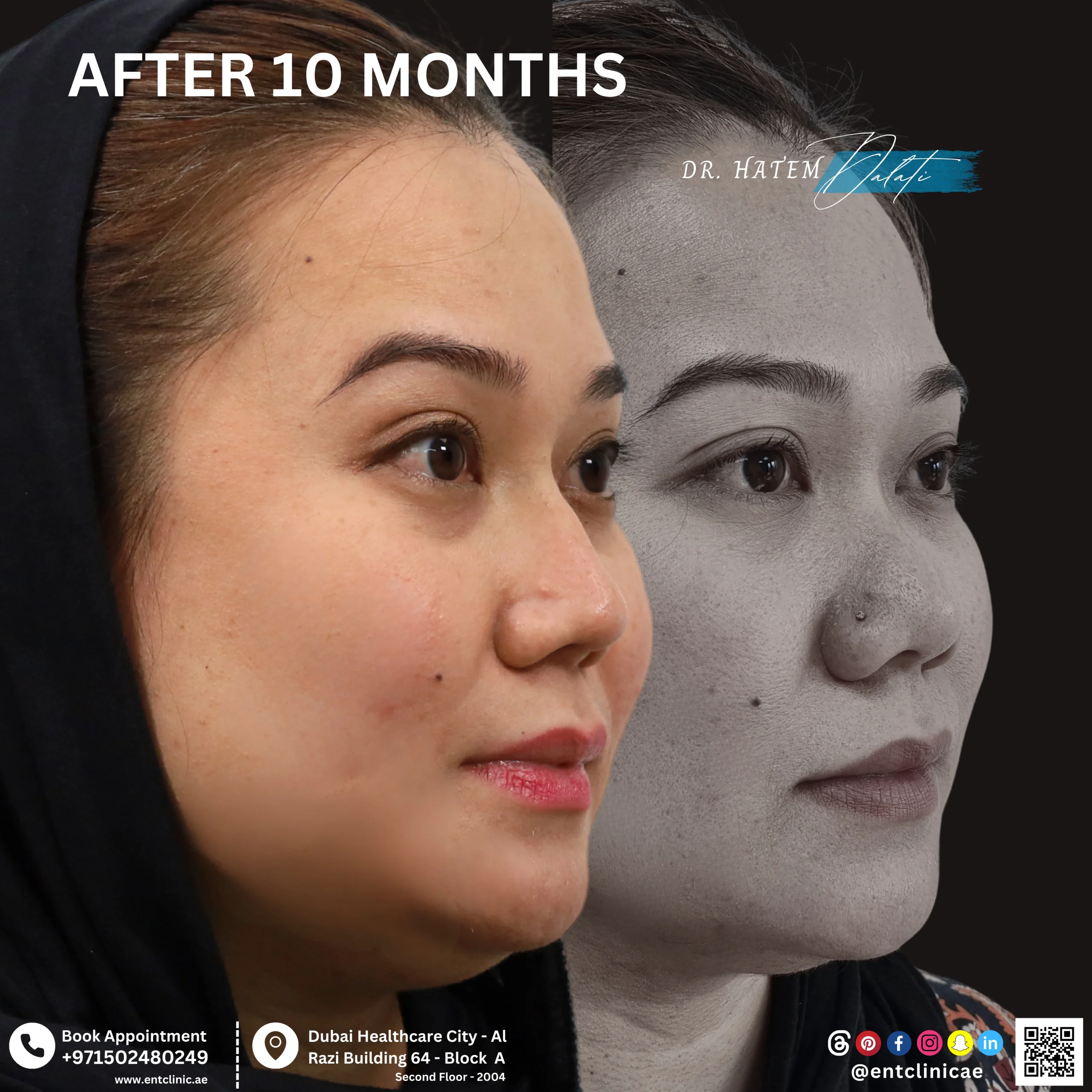 Patient before and 10 months after ethnic rhinoplasty showing natural nasal refinement while maintaining facial identity in three quarter view