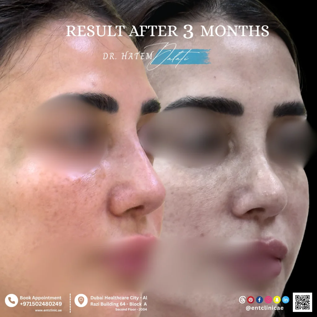 تشوّه الأنف السرجي مع انهيار الحاجز الأنفي بعد عملية تجميل أنف سابقة و النتيجة بعد 3 شهور من إجراء عملية تجميل الأنف والحاجز الأنفي مع استخدام ترقيع الغضاريف
