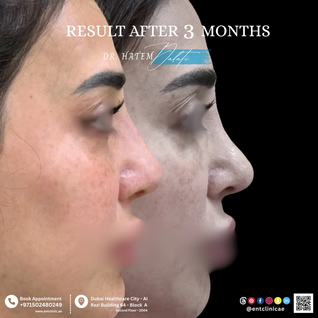 Side profile before and after revision septorhinoplasty with septal reconstruction showing restored nasal contour and structural support