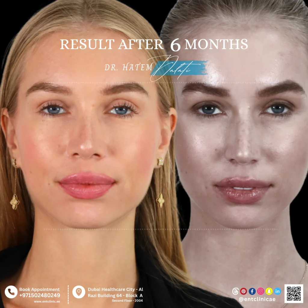 Before-and-after rhinoplasty results at 6 months after surgery frontal view