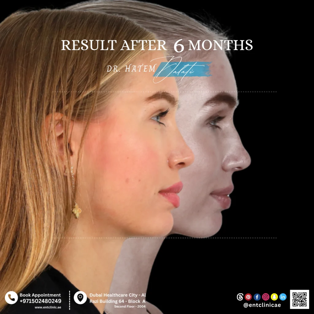 Before-and-after rhinoplasty results at 6 months after surgery profile view